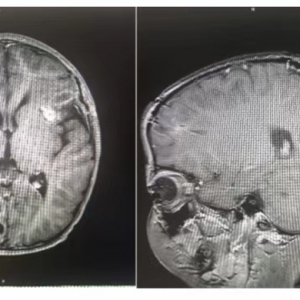 4岁男孩颅内七八个脑脓肿，最大如鸡蛋！新华专家两次“拆弹”转危为安 ... ... ...
