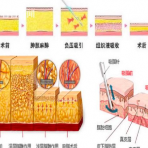 女孩在杭州一医美机构全麻抽脂后心跳、呼吸骤停，仍在抢救 ... ...