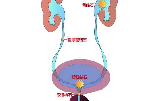 你还不爱喝水吗？这种病疼起来像刀割，越来越多年轻人中招 ... ... ...