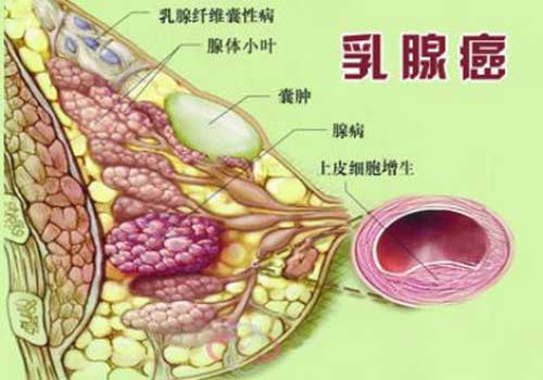 首个能解释结果的AI乳腺癌诊断系统面世