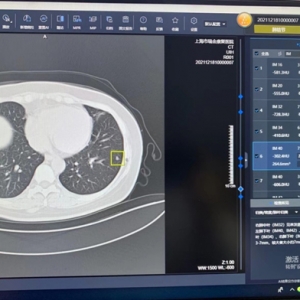 “AI医生”来了！瑞金康复医院引进肺结节智能筛查AI系统