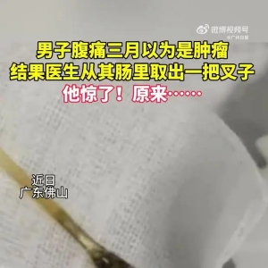 男子腹痛三月以为是肿瘤结果是叉子