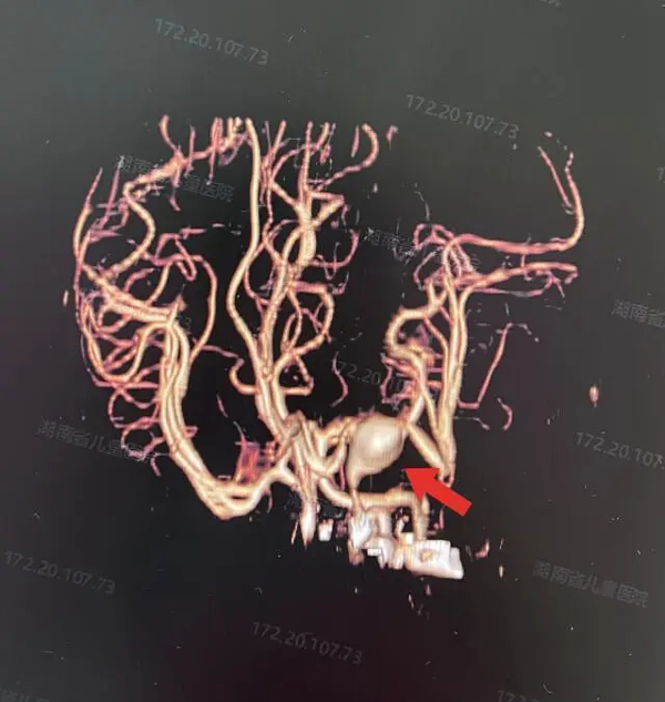 全国最低龄！16天新生儿颅内长出巨大动脉瘤，切除！